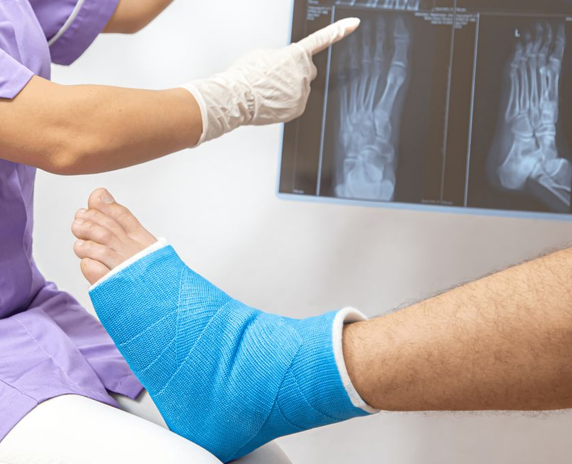 Fracture Rehabilitation